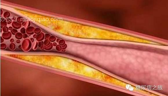 关于血脂异常的9件事 