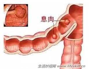 莫把息肉当痔疮！