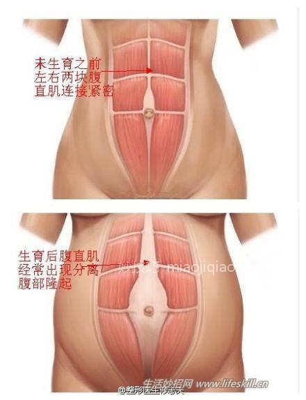 怎么让“水桶腰”恢复成“小蛮腰”？